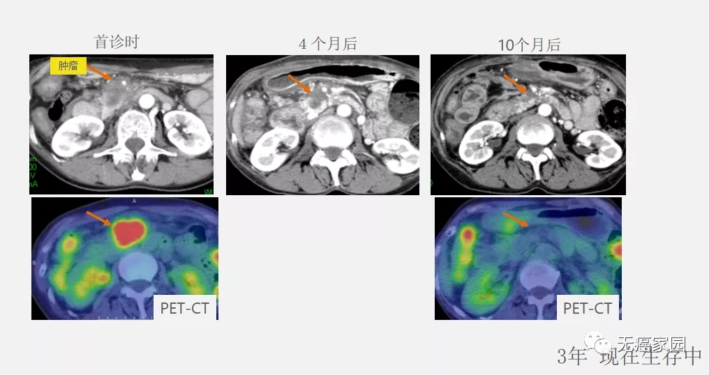 胰腺癌质子治疗效果