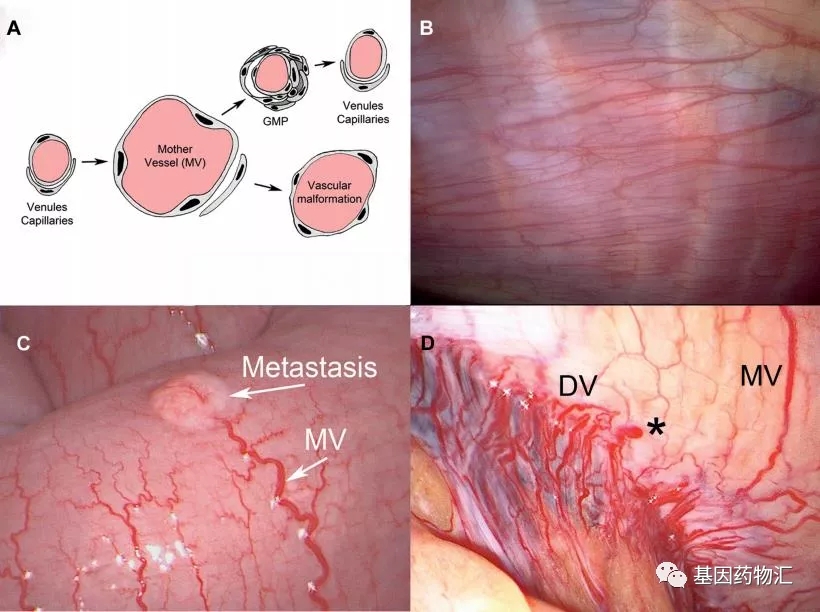 癌性腹水