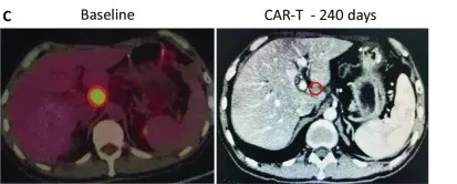 CAR-T细胞免疫疗法治疗胰腺癌的效果