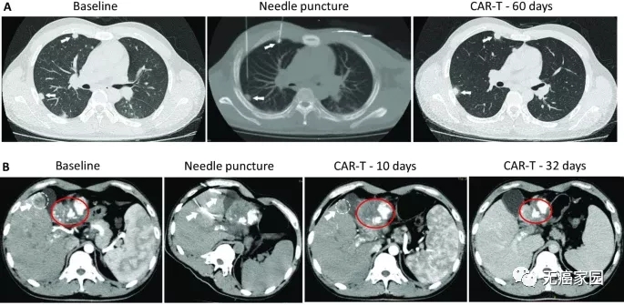 CAR-T细胞治疗肝癌的效果