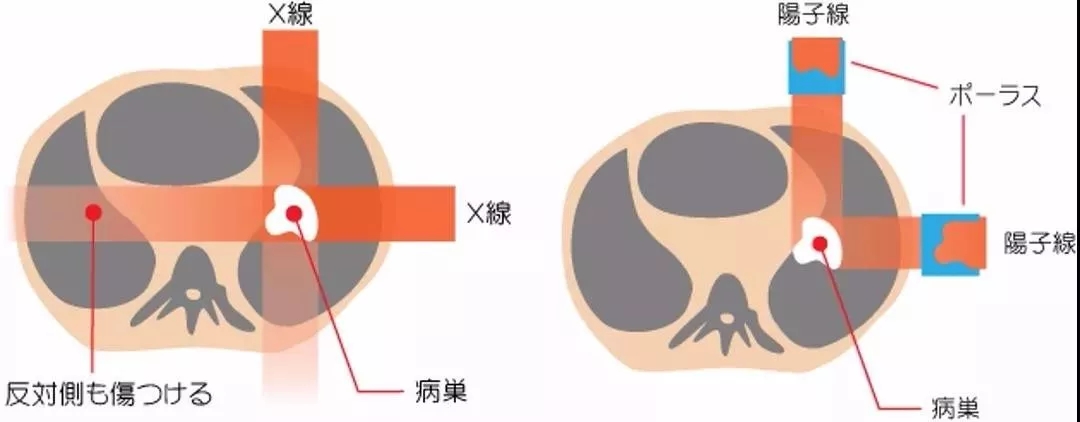 质子治疗与X线放疗的比较