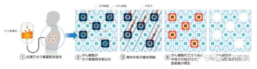 BNCT治疗流程