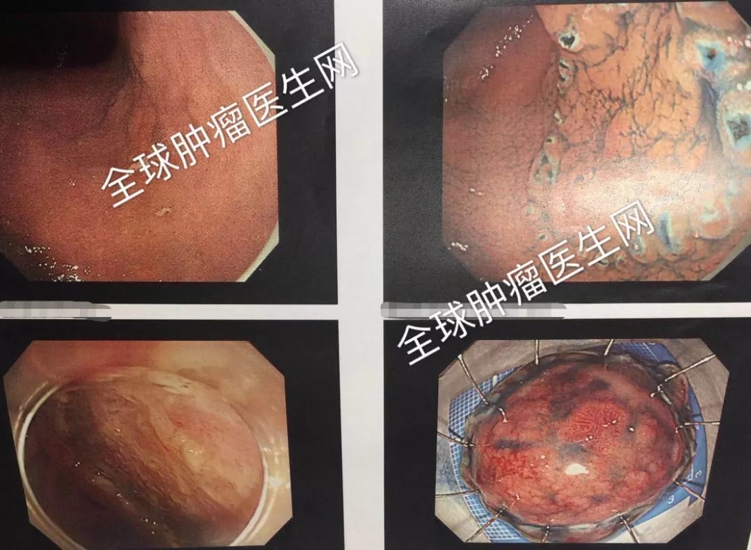 亚洲排名第一,全球排名第二,胃癌5年生存率高达80％的医院,为啥这么牛!