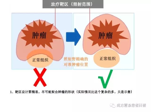 放疗靶区