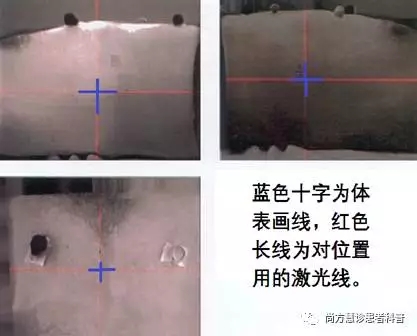 放疗模拟定位