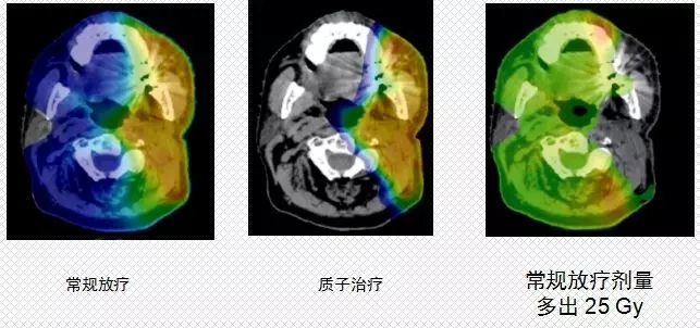 头颈肿瘤质子治疗和常规放疗辐射剂量和照射面积对比