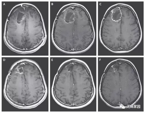 肿瘤缩小50％,反应率高达33％,新药组合直击"胶质母细胞瘤"
