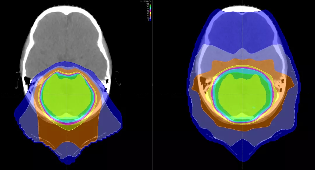 脑瘤质子治疗和传统放疗照射范围对比