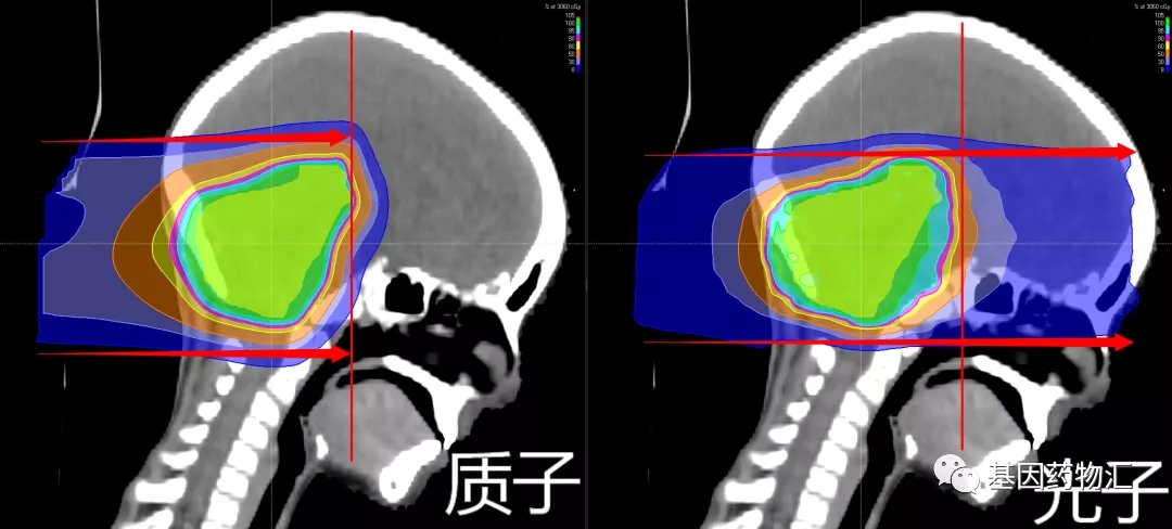 放疗会导致别的癌症吗