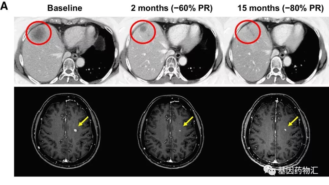 持续缓解20个月!多脏转移、一药缓解,肺癌的三大突变都有机会用这款药