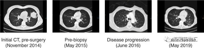 有人稳定缓解5年,也有人用药3个月进展?找到适合的方案,才是治疗这类难治肺癌的关