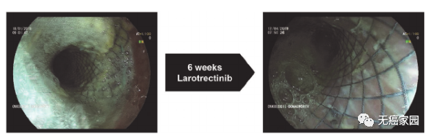 Larotrectinib治疗食管癌的效果