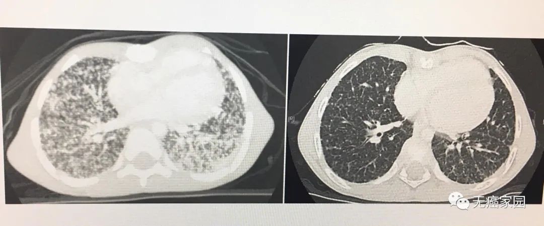 Larotrectinib治疗甲状腺癌的效果