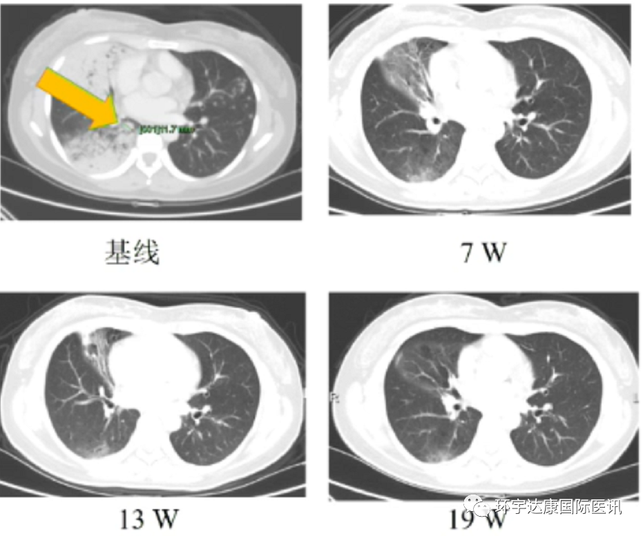 他雷替尼治疗ROS1 G2032R耐药突变的效果