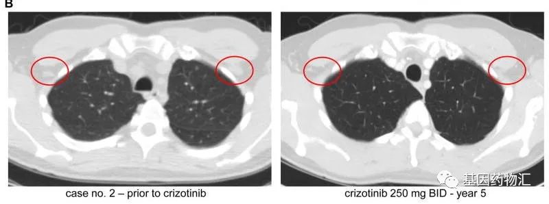 克唑替尼治疗肺癌前后对比