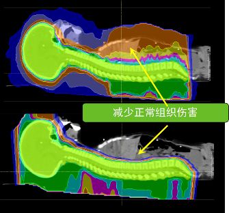 质子治疗儿童肿瘤