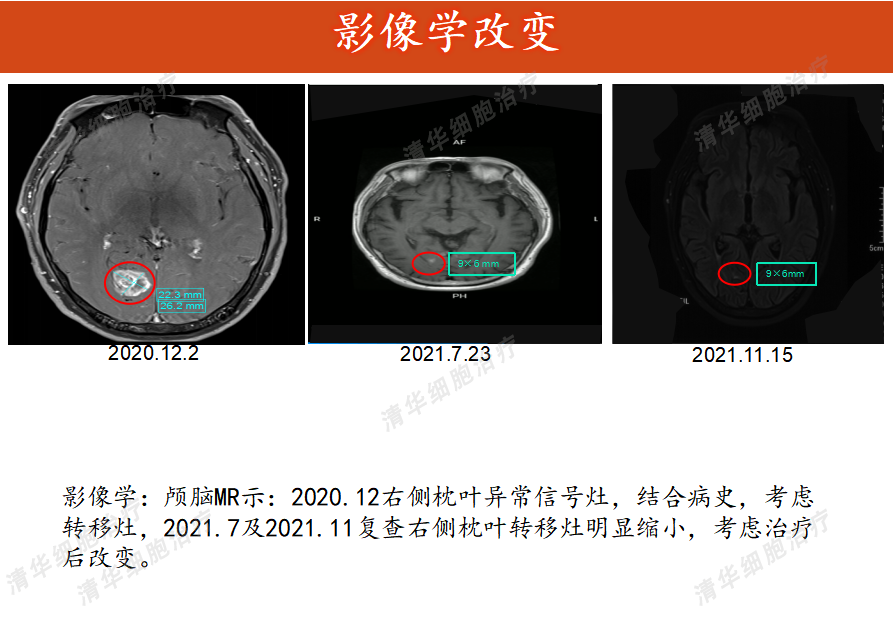 细胞免疫治疗后的肺癌影像图