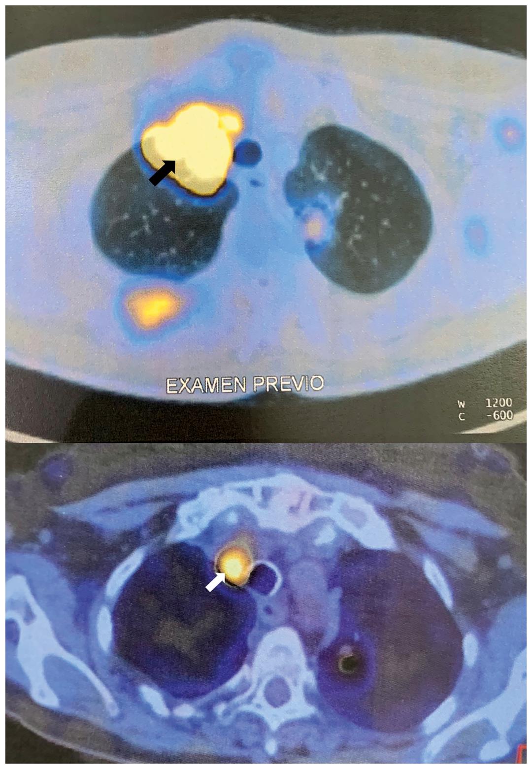 拉罗替尼治疗效果111