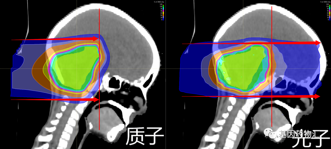 肺癌脑转移质子治疗