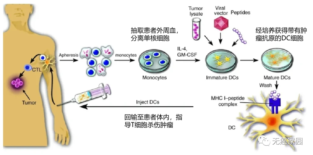 完全缓解后不可松懈,预防复发是关键!树突状细胞疫苗让癌症患者长期缓解,疗效持久!