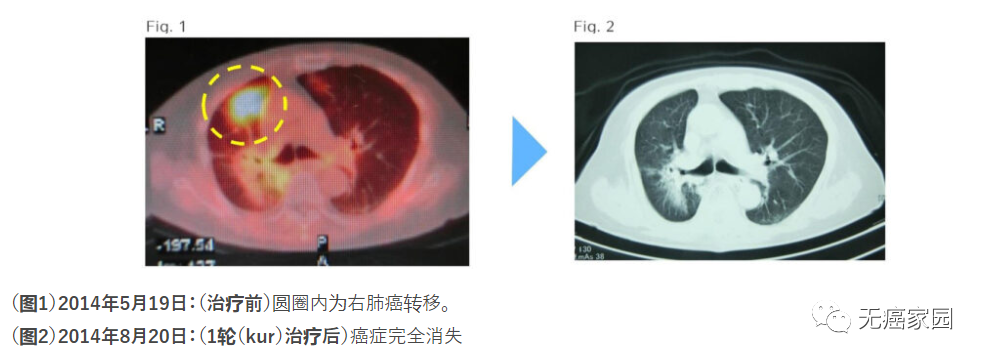 树突状细胞疫苗治疗肺癌的效果