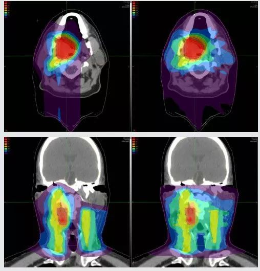 头颈癌质子治疗计划