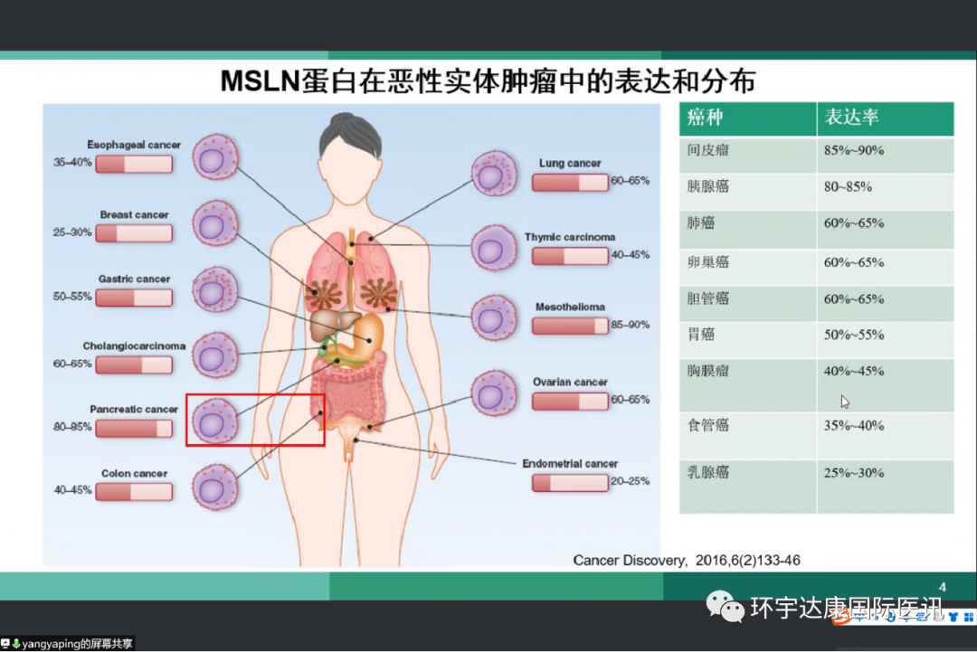 MSLN蛋白在恶性实体肿瘤中的表达和分布