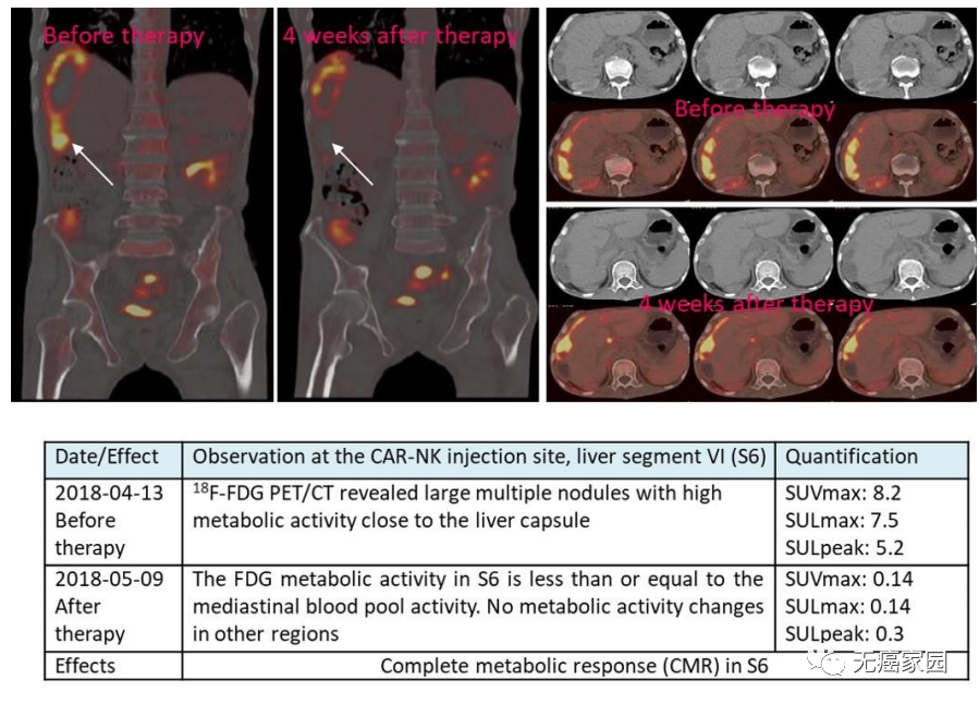 CAR-NK 细胞治疗后肝转移病灶 PEC-CT 结果对比图