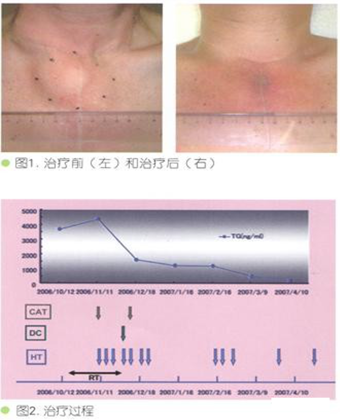 热疗联合细胞免疫治疗甲状腺癌的效果