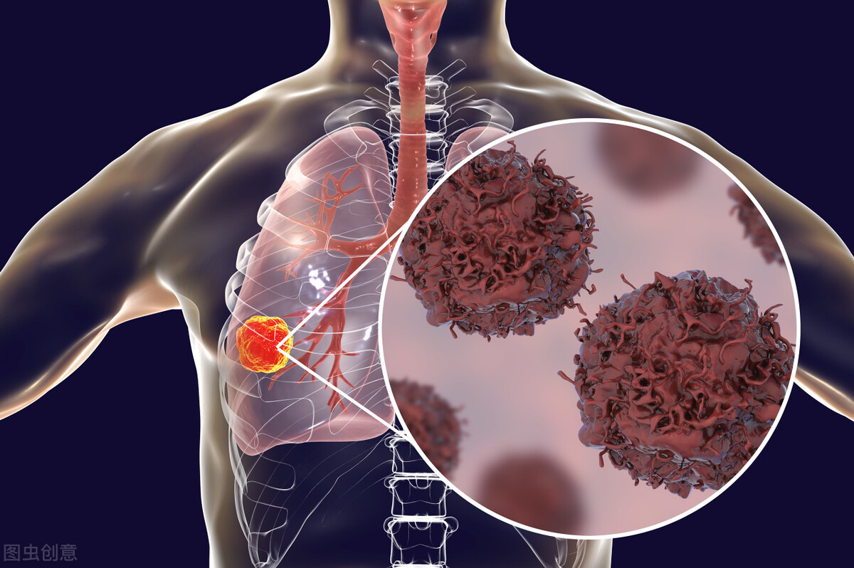 肺癌为何对中国人情有独钟?刚刚!新抗癌药已获批或可摆脱困境