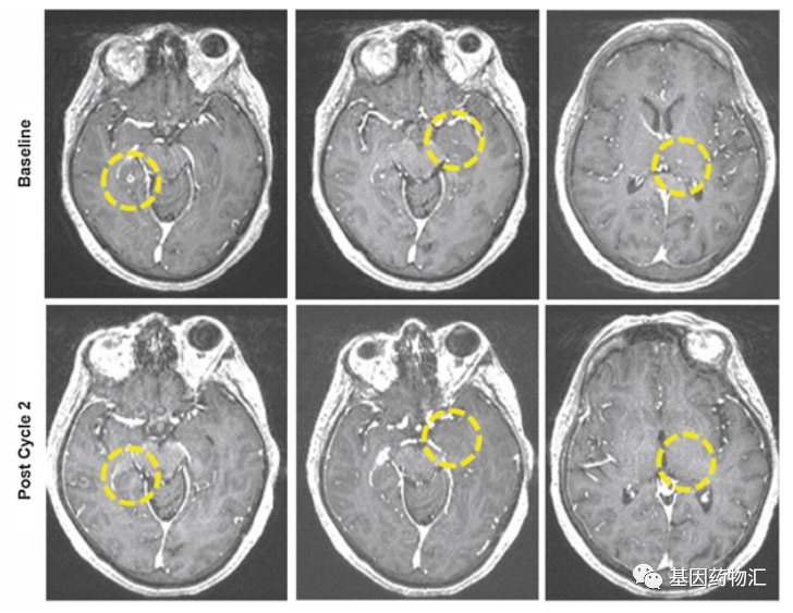 治疗2个周期,病灶缩小31%,3个脑转移病灶消失!KRAS突变非小细胞肺癌关注!