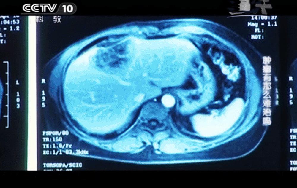 细胞免疫治疗后的乳腺癌影像