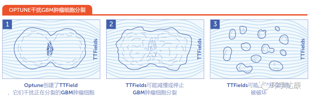 电场治疗肿瘤的原理