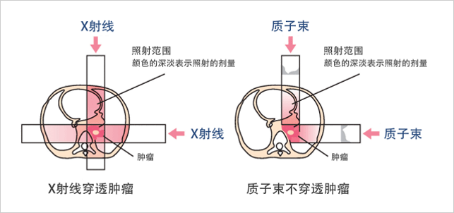 质子放疗和普通放疗的穿透对比