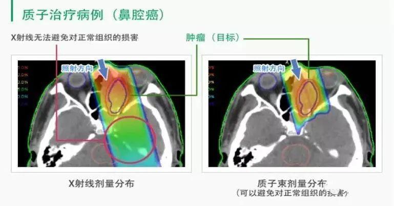 质子治疗鼻腔癌