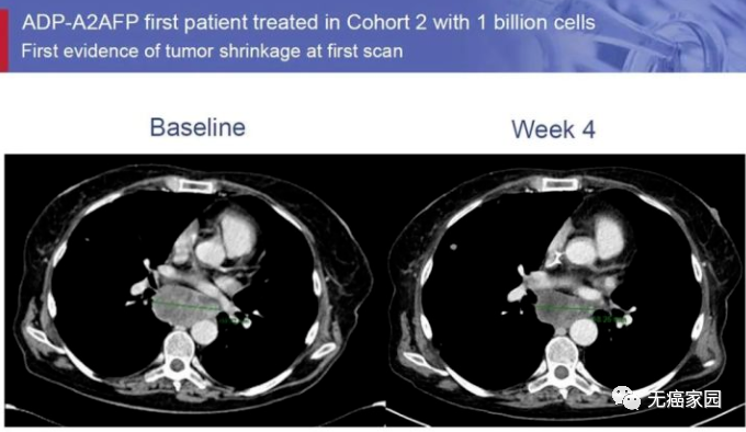 TCR-T疗法ADP-A2AFP治疗肝癌的效果