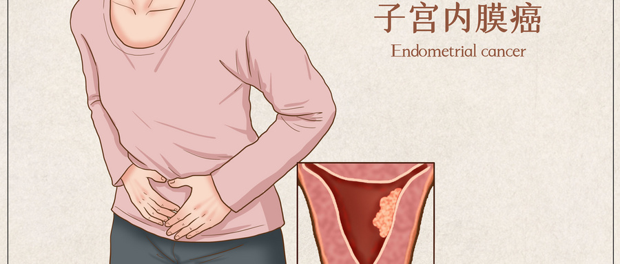 日本治疗子宫内膜癌的优势是什么