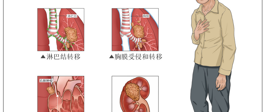 肺癌反复"找"上门怎么办?延长生存期、预防复发采取这些措施才