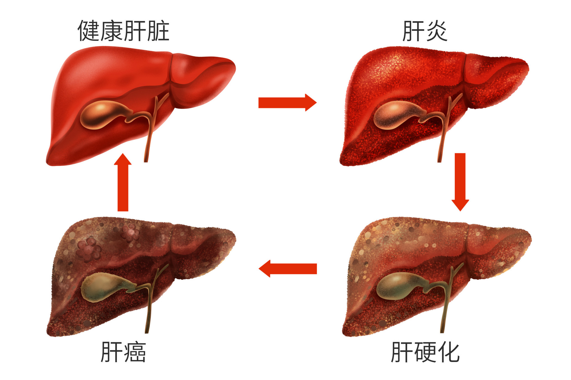 为啥肝癌总找上中国人?别慌!质子治疗成老年肝癌、巨大肝癌、伴肝硬化及肝癌复发新选