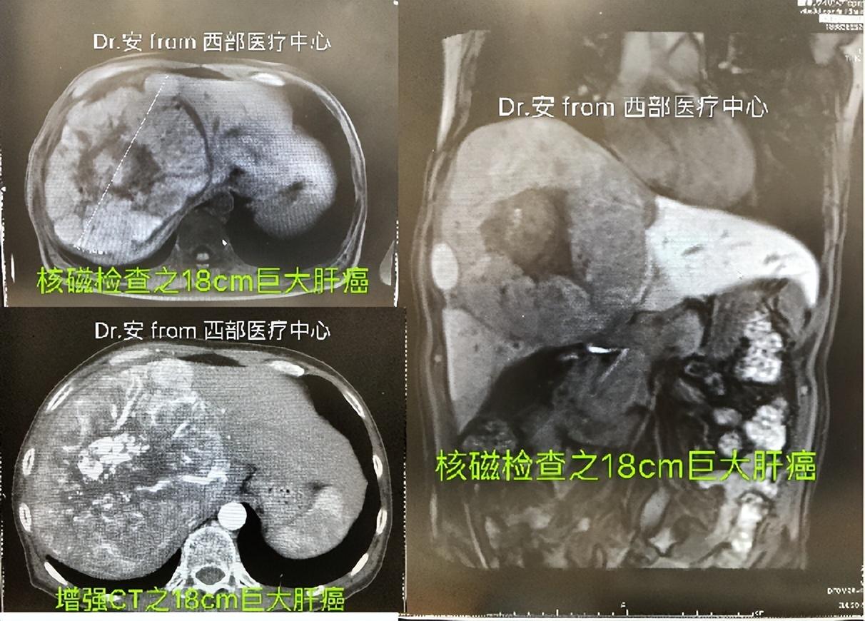 陕北18CM巨大肝细胞癌患者,8个月后病灶消失,已度过6年