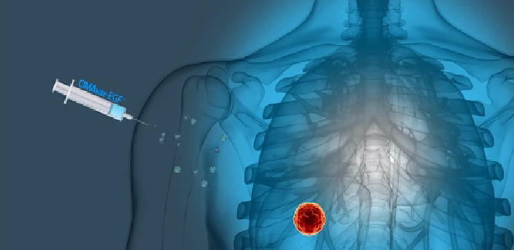 预防复发,延长生存期!肺癌疫苗Cimavax-EGF公布新数据