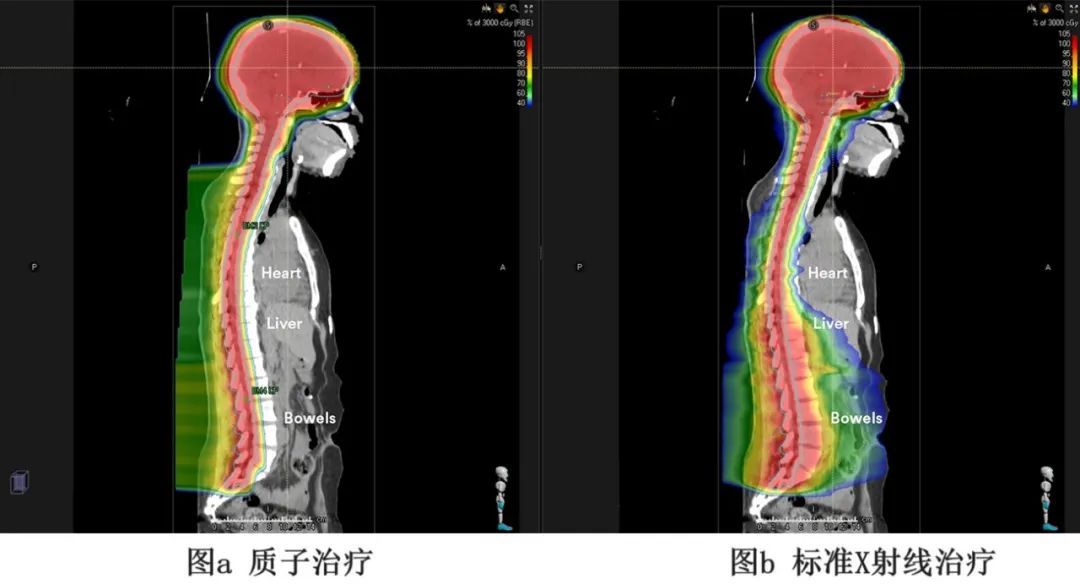 质子治疗精准爆破儿童肿瘤,放疗伤害降低,疗效和生存质量双保险!