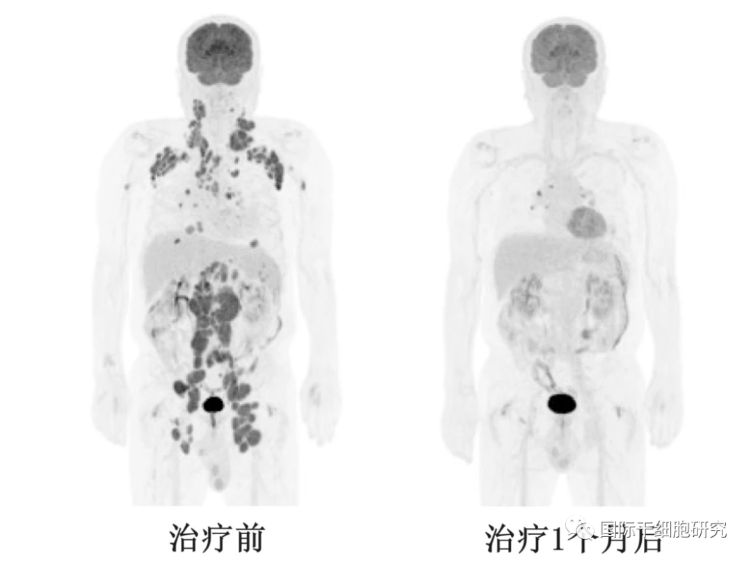 完全缓解可达100%!2023年CAR-T疗法重大突破盘点,晚期肿瘤有望&quo