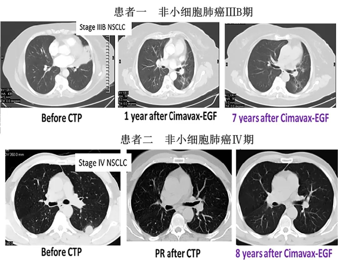 肺癌:古巴肺癌疫苗5年生存率从0升至23%