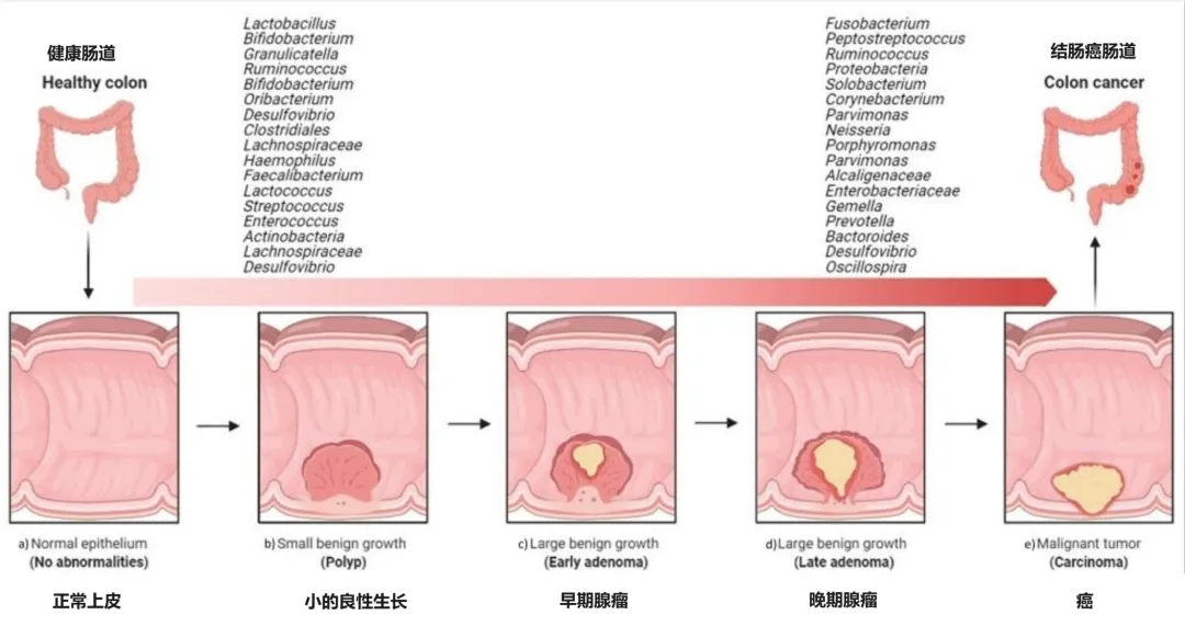 肠道益生菌在结直肠癌发生和进展中的影响