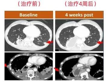 CT401治疗胃癌的效果