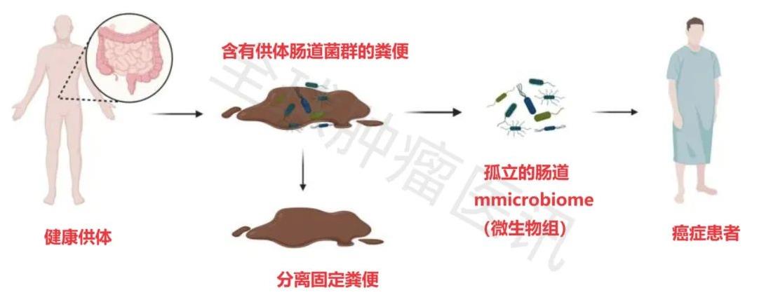 粪菌移植