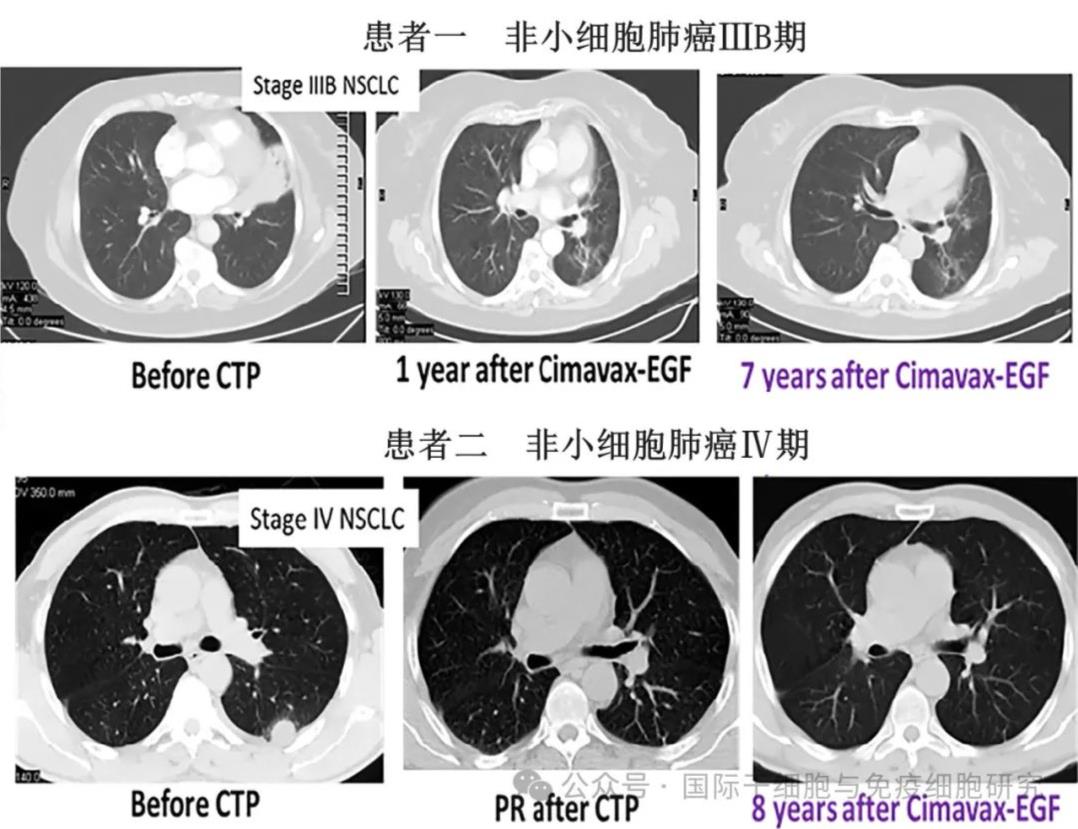 肺癌术后复发的"罪魁祸首"找到了,六大方法助您降低癌细胞&q