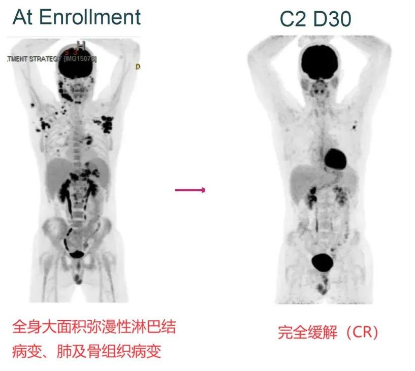 NK细胞疗法治疗霍奇金淋巴瘤的效果