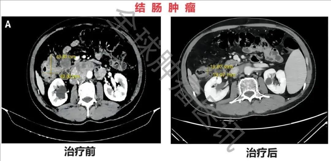 肠道菌群治疗结肠癌的效果